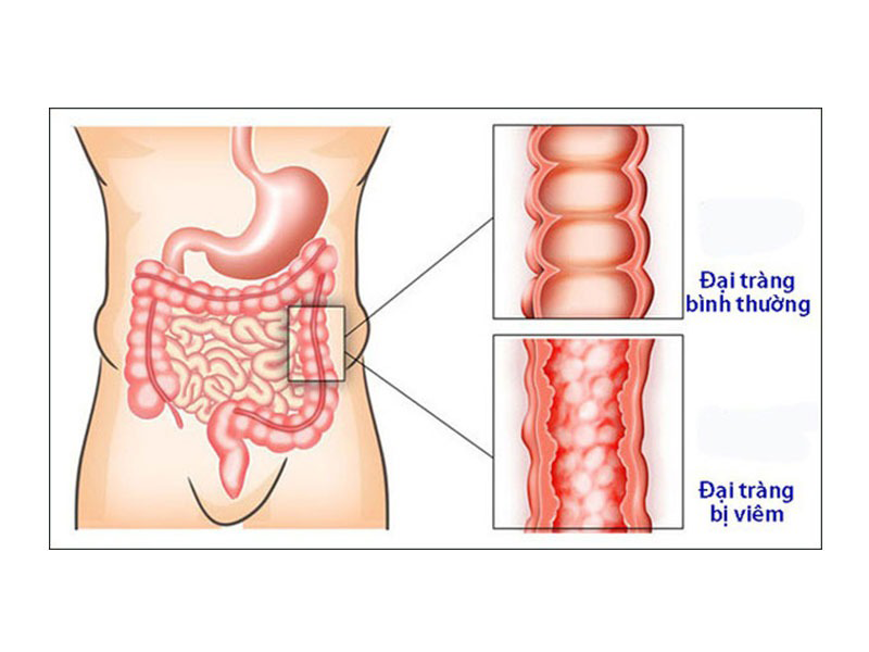 bacillus-bao-tu-loi-khuan-ho-tro-dac-luc-nguoi-viem-dai-trang