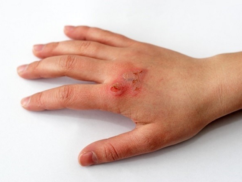 be-trai-13-tuoi-o-ha-noi-mac-giang-mai-do-bi-lam-dung-tinh-duc-dong-tinh