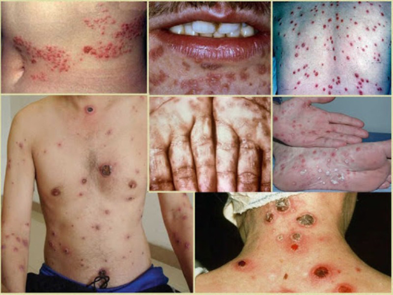 benh-giang-mai-tang-nhanh-co-the-ton-thuong-tim-gan-va-tu-vong