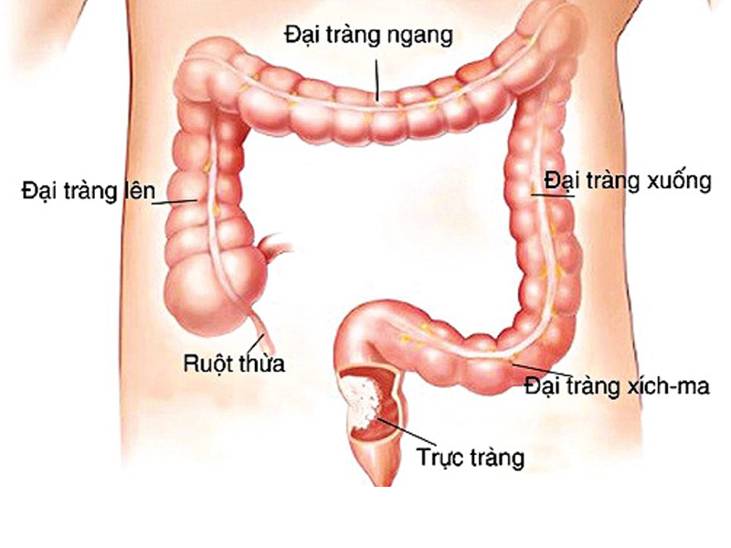 cach-don-gian-ngan-ngua-ung-thu-dai-truc-trang-ngay-tai-nha