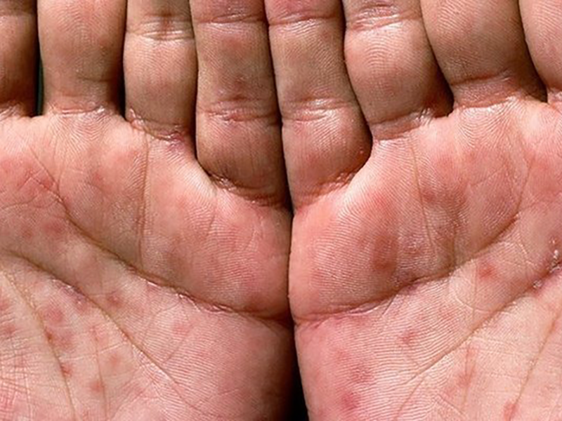 dau-hieu-canh-bao-benh-giang-mai-dang-tiem-an-trong-ban