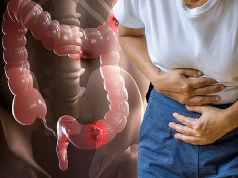 dau-hieu-khien-nhieu-nguoi-nham-lan-ung-thu-ruot-voi-benh-tri
