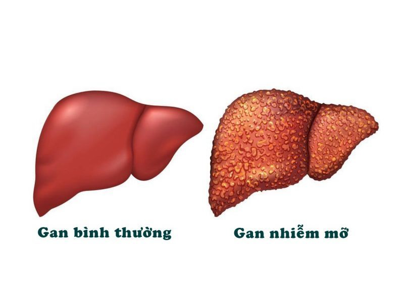 gan-nhiem-mo-sat-thu-tham-lang-gay-ung-thu-gan