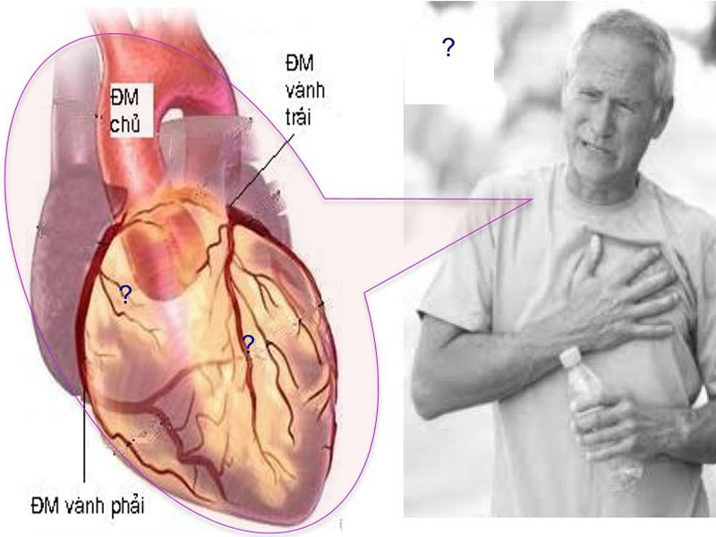kiem-soat-trieu-chung-dau-that-nguc-cua-benh-dong-mach-vanh