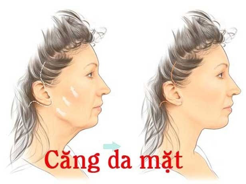 phau-thuat-cang-da-mat-duoc-nhieu-chi-em-ua-chuong-nguy-hiem-the-nao