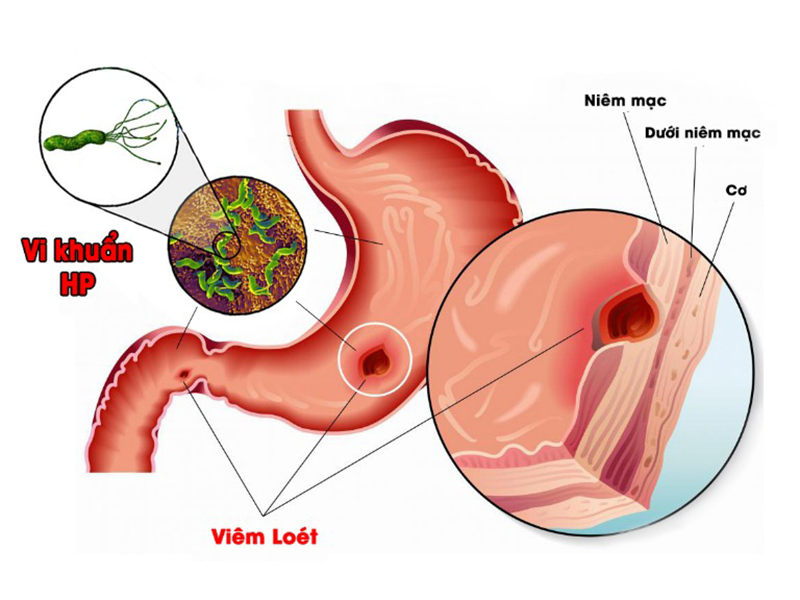 qua-nhieu-vi-khuan-hp-sinh-song-trong-da-day-co-the-se-cau-cuu-bang-3-tin-hieu-nay