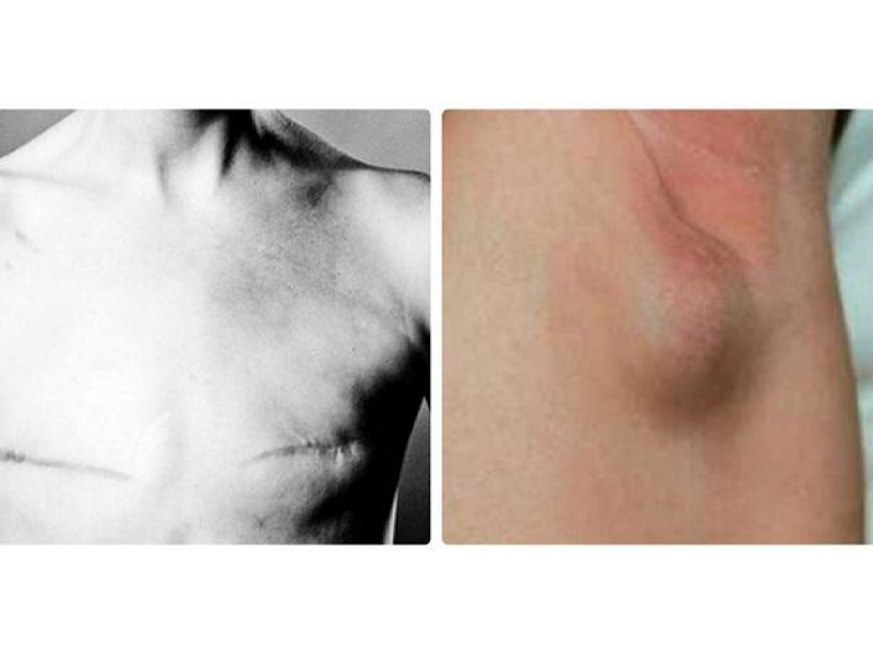 thay-hach-o-nach-dau-hieu-ung-thu-di-can-ma-khong-biet