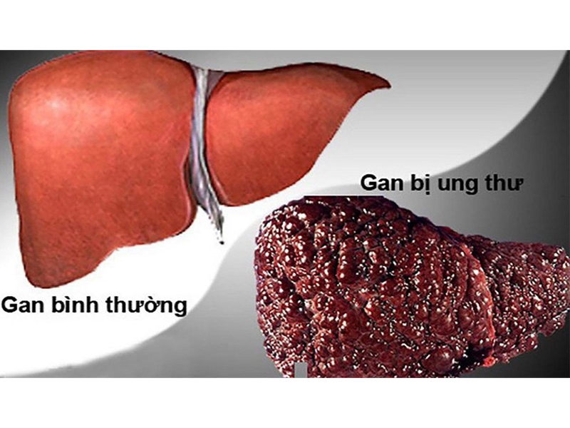 ung-thu-gan-vn-xep-thu-4-the-gioi-nhung-cach-chua-moi-nhat-benh-nhan-can-biet
