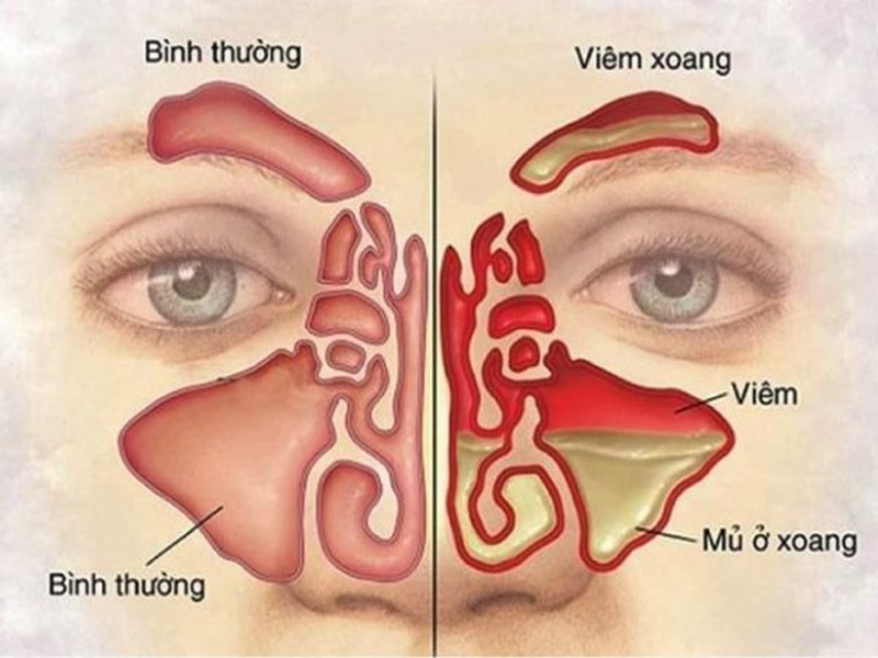 video-chua-benh-ky-quai-bat-sau-tren-mat-de-chua-viem-xoang