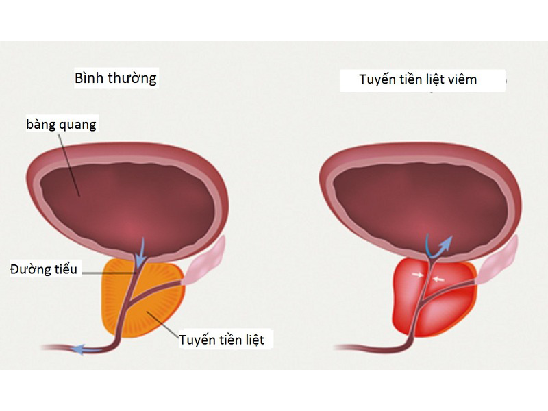 xuat-tinh-ra-mau-benh-gi