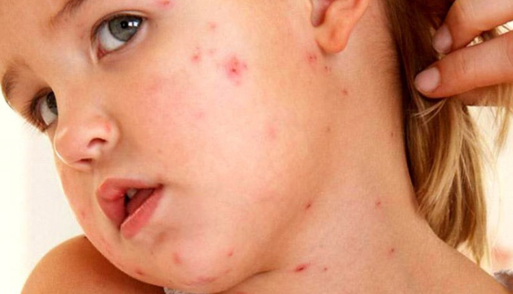 ban-soi-la-gi-dau-hieu-nhan-biet-nguyen-nhan-va-cach-phong-ngua-hieu-qua-benh-soi-trong-cong-dong