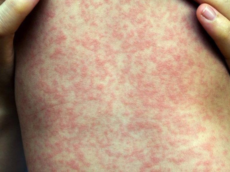 cach-nhan-dien-va-phong-ngua-de-khong-bi-benh-soi-o-tre-em