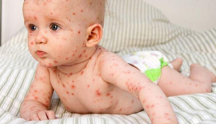 nhung-dieu-ban-can-biet-de-phong-ngua-benh-soi